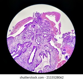 Tissue From Gastro-jejunostomy Stomal Site ( Endoscopic Biopsy) Hematoxylin And Eosin Stained Microscopic 40x Show Chronic Chronic Nonspecific Gastritis With Mild Dysplasia.