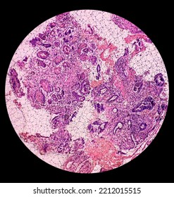 Tissue From Gastro-jejunostomy Stomal Site (endoscopic Biopsy): Chronic Nonspecific Gastritis With Mild Dysplasia. Show Gastric Mucosa, Chronic Inflammatory Cells, Lamina Propria And Dysplastic Change