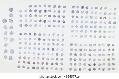 Tissue Microarray - A Pathology Technique To Screen Muliple Tissue Samples For Biomarkers Especially Cancer Prognostic Markers On Biopsy Samples.