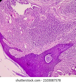 Tissue From Scalp: Tumors Of Skin, Microscopic Image Of A Dermatofibroma, Benign Tumor, Show Pseudoepitheliomatous Hyperplasia, Benign Neoplasm, Inflammatory Cells.