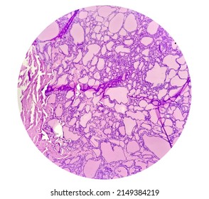 Tissue From Supra-scapular Bursa Hematoxylin And Eosin Stained Microscopic Show Synovial Sarcoma, Monophasic.