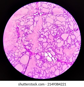 Tissue From Supra-scapular Bursa Hematoxylin And Eosin Stained Microscopic Show Synovial Sarcoma, Monophasic.