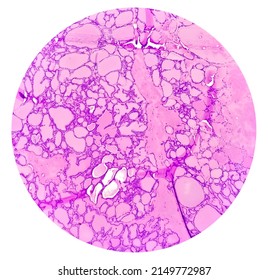 Tissue From Supra-scapular Bursa Hematoxylin And Eosin Stained Microscopic Show Synovial Sarcoma, Monophasic.