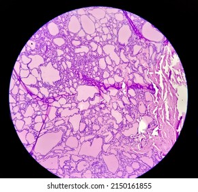 Tissue From Supra-scapular Bursa Hematoxylin And Eosin Stained Microscopic Show Synovial Sarcoma, Monophasic.