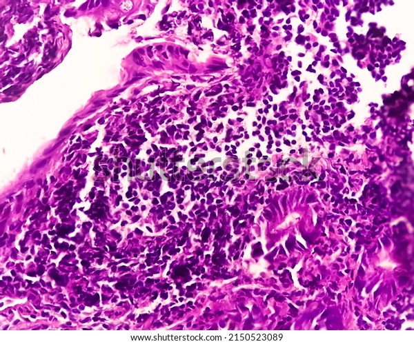 Tissue from terminal ileum: Chronic\
nonspecific ileitis or inflammation of the ileum, is often caused\
by Crohn\'s disease. inflammatory bowel disease\
(IBD).