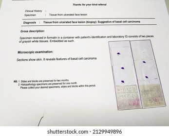 Tissue From Ulcerated Face Lesion (biopsy) Microscopic Show  Basal Cell Carcinoma. Microscopic Glass Slide And Testing Report.