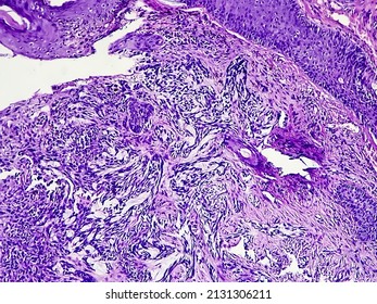 Tissue From Ulcerated Face Lesion (biopsy) Microscopic Show  Basal Cell Carcinoma. Zoom Image