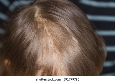 Toddler With Cradle Cap On His Head