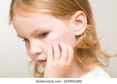 Toddler Girl Fingers Itching Red Rash On Cheek Skin From Bite Of Mosquito Or Food Allergy On Light Gray Background. Side View. Closeup.