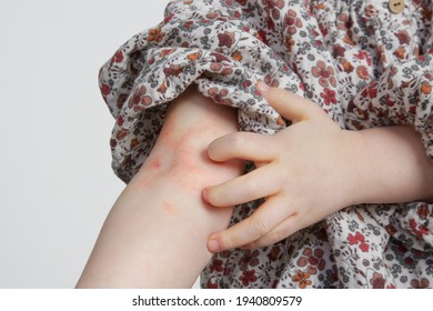 Toddler Girl Suffering From Atopic Dermatitis, Close Up Image. Red And Itchy Skin. Eczema On Kid's Arm.