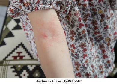 Toddler Girl Suffering From Atopic Dermatitis, Close Up Image. Red And Itchy Skin. Eczema On Kid's Arm.