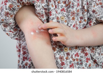 Toddler girl suffering from atopic dermatitis, close up image. Red and itchy skin. Eczema on kid's arm.