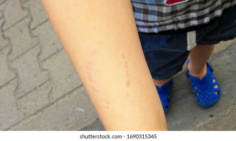 Toddler's Bite Marks On Another Kids Arm - Aggressive Toddlers Behavior Psychology