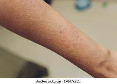 Toddler's Bite Marks On Mothers Arm - Aggressive Toddlers Behavior Psychology.