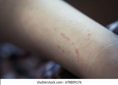 Toddler's Bite Marks On Mothers Arm - Aggressive Toddlers Behavior Psychology