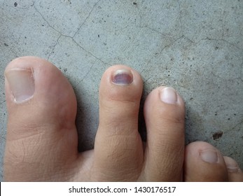 Toe With Blood Clot Under The Nail. A Red Black Stain Of Blood Clot