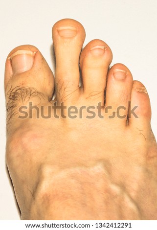 Toe nail and foot imperfections
