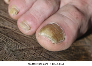 Toe Nail Fungus. Fungal Infection On The Toenails. Toes With Fungus.