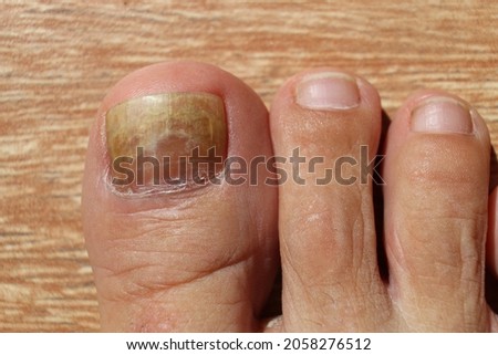 Toe nail with psoriasis and healthy toe nails; Psoriatic nail; close-up.