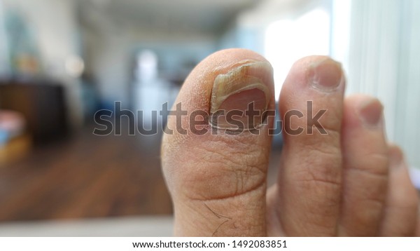 Toe Nails Dry Feet Stock Photo (Edit 