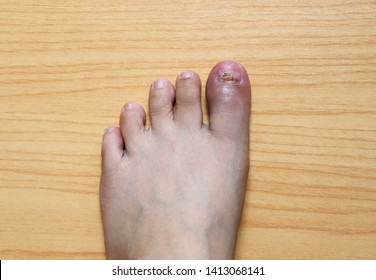 Broken Big Toe Images, Stock Photos & Vectors | Shutterstock