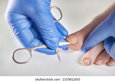 The Toenail Is Affected By The Fungus. Nail Fungus Treatment.
