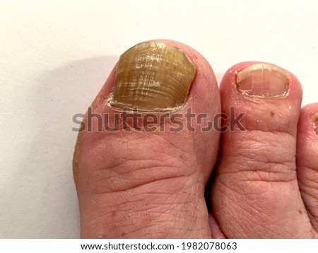 Toenail care for nail fungus - thickened big toe nail of a person suffering from Onychomycosis, a fungal infection causing yellowing and thickening of the toenail.