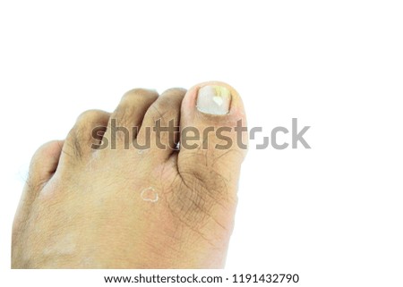 Toenail fungus medication foot doctor at clinic isolate white Background