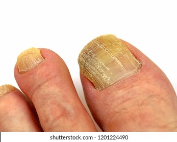 Onychomycosis High Res Stock Images Shutterstock Fingerfein Naegel Wimpern Und Kosmetik Michelstadt