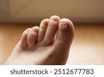 Toenail fungus that has affected the toenails.