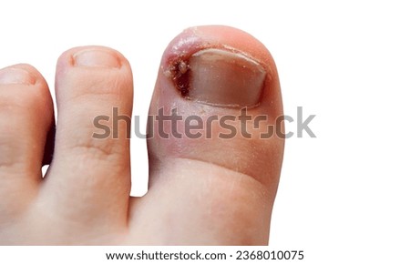toenail infection in human, toenails on a foot, isolated on white background, pain in the big toe closeup