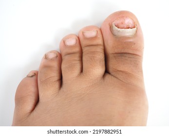 Toenail Infection In Woman. Closeup Photo, Blurred.