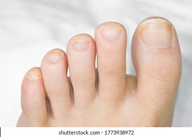 Toenails On A Woman's Feet