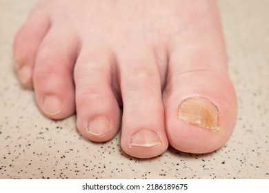 Toenails Of Woman With Fungal Infection. Brown Bruise Under Nail Of Big Toe. Senior Woman Touches Injured Toenail By Index Finger, Extreme Closeup