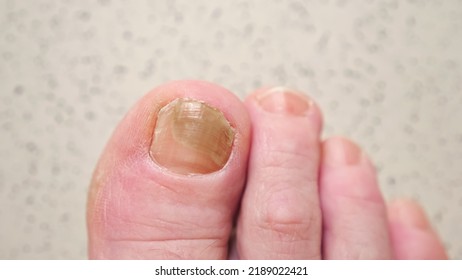 Toenails Of Woman With Fungal Infection. Brown Bruise Under Nail Of Big Toe. Senior Woman Touches Injured Toenail By Index Finge, Top View