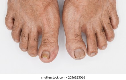Toes of Asian elder man. Concept of toenails’ problems.