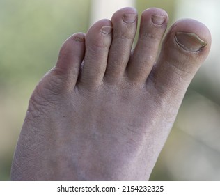 Toes with little toes bent, and toes that are not maintained
