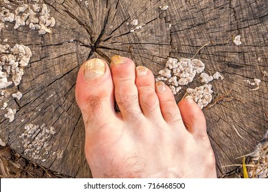 The Toes Of A Male Foot, Infected With A Nail Fungus, On A Grey Cracked Stump Covered With White Mold Fungi.