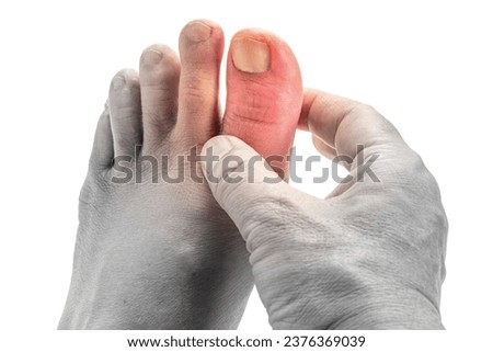 Toes of a man with gout on a white background