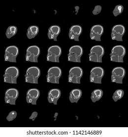 Tomographic Image Of A Human Skull On Sagittal Plane