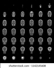 Tomography Images Of A Human Skull On A Coronal Plane.