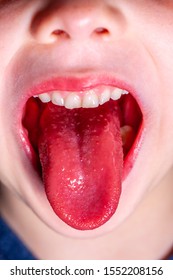 Tongue Of A Child With Scarlet Fever - Strawberry Tongue.