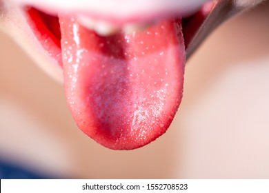 Tongue Of A Child With Scarlet Fever - Strawberry Tongue.