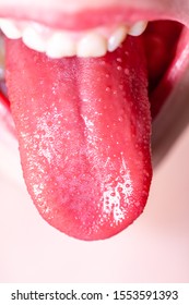 Tongue Of A Child With Scarlet Fever - Strawberry Tongue.