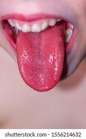 Tongue Of A Child With Scarlet Fever - Strawberry Tongue.