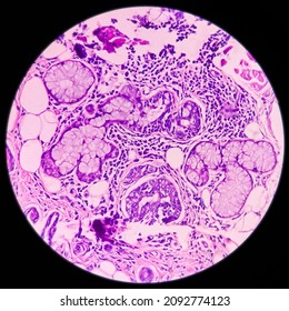 Tongue With Mandible Cancer, Oral Cancer, Invasive Squamous Cell Carcinoma, Grade-II. Lymphovascular Invasion Present, Microscopic View.