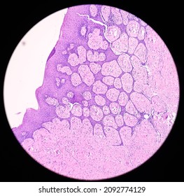 Tongue With Mandible Cancer, Oral Cancer, Invasive Squamous Cell Carcinoma, Grade-II. Lymphovascular Invasion Present, Microscopic View.