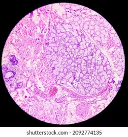 Tongue With Mandible Cancer, Oral Cancer, Invasive Squamous Cell Carcinoma, Grade-II. Lymphovascular Invasion Present, Microscopic View.