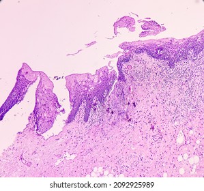 Tongue With Mandible Cancer, Oral Cancer, Invasive Squamous Cell Carcinoma, Grade-II. Lymphovascular Invasion Present, Microscopic View.