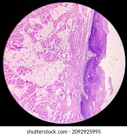 Tongue With Mandible Cancer, Oral Cancer, Invasive Squamous Cell Carcinoma, Grade-II. Lymphovascular Invasion Present, Microscopic View.